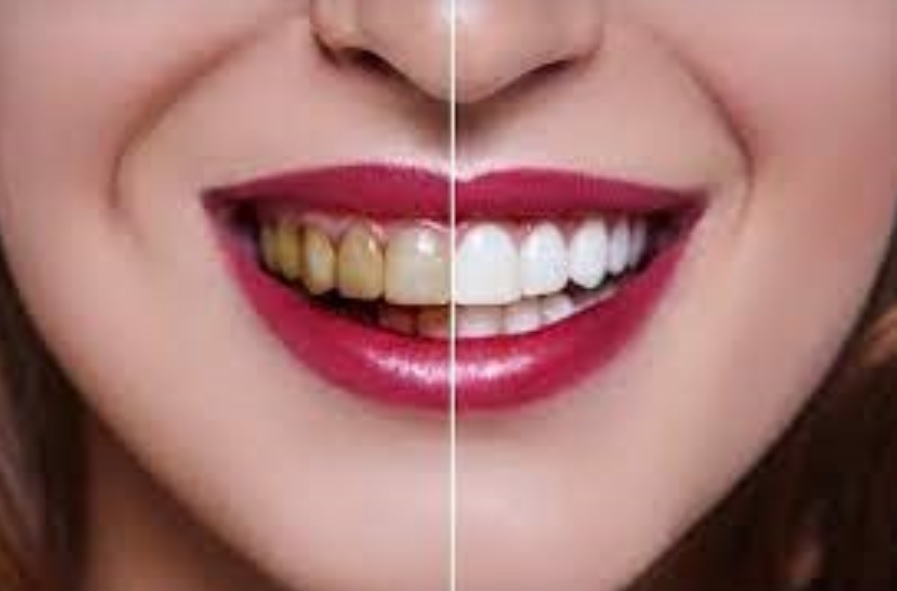 Teeth Whitening Leicetser