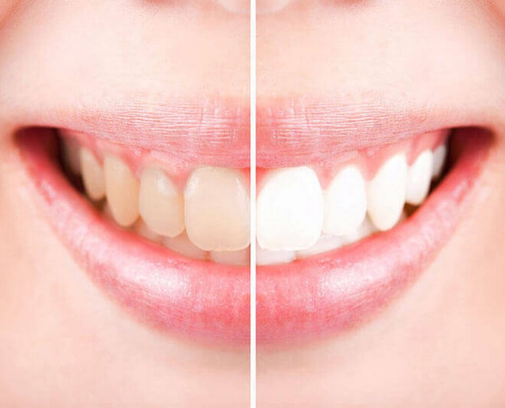 Teeth Whitening