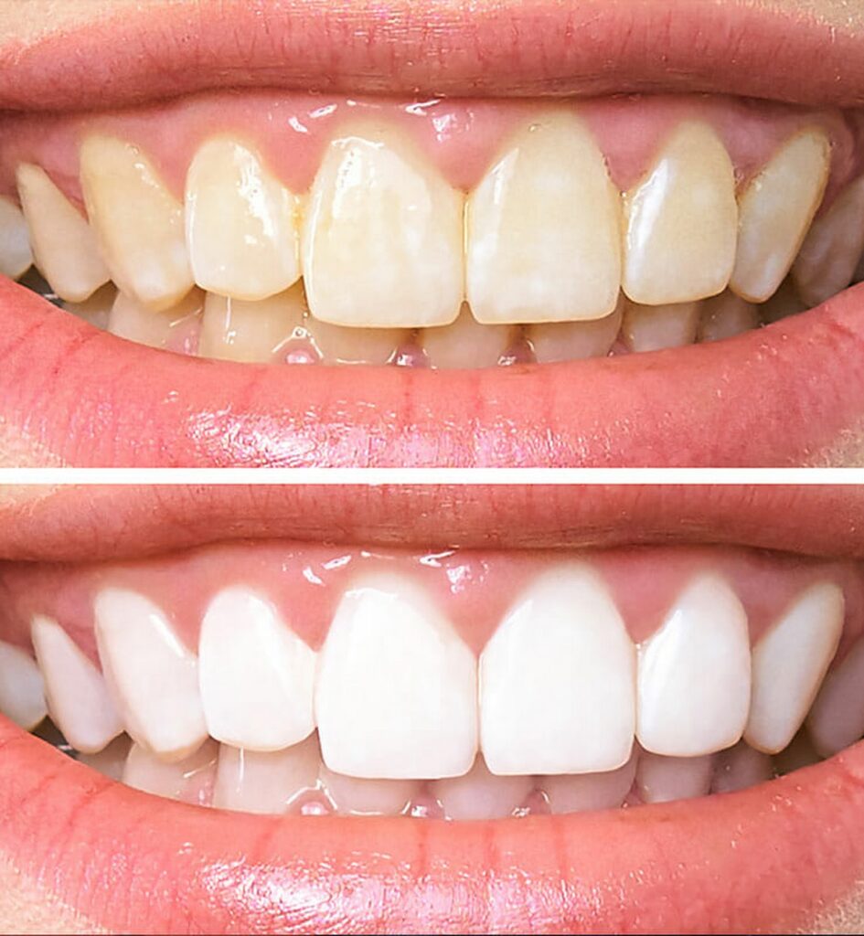Teeth Whitening